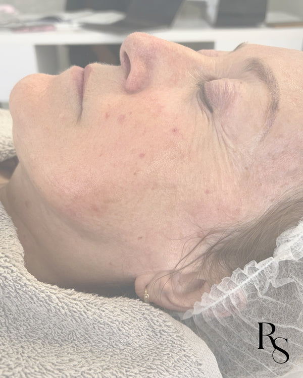 Facial Glow with pHformula